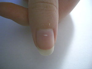 Aggregate more than 145 thumb nail white spot