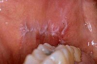 Lichen planus וויקהאם's.jpg