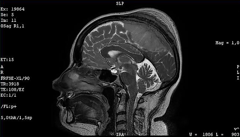 File:Meningioma of the sagittal sinus isolated.jpg