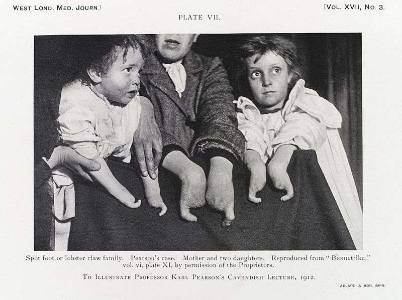 File:Mother and daughters with lobster claw deformity, c. 1912 Wellcome L0033874.jpg
