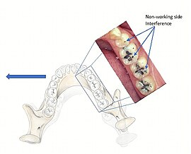 Essential requirements of a non-occlusal mandibu- lar reference