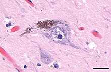 Photomicrograph of neuromelanin (brown material) in a neuron of the substantia nigra. Hematoxylin and eosin stain. The scale bar is 20 microns (0.02mm) in length. Neuromelanin in a neuron of the substantia nigra.jpg