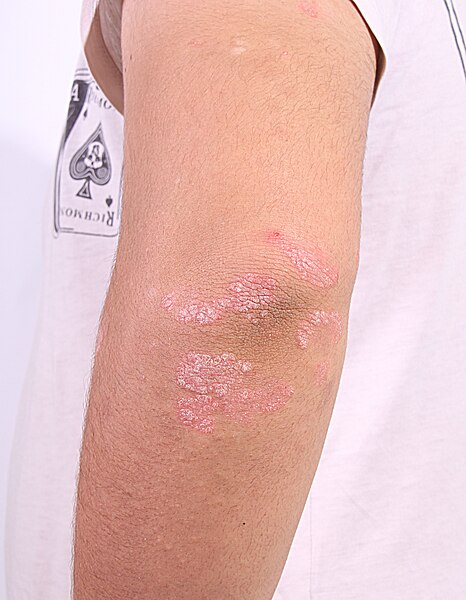 File:Psoriasis 001.jpg