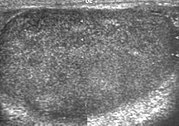 Scrotal ultrasonography of leukemia.jpg