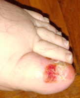 Advanced fungal infection of the big toe