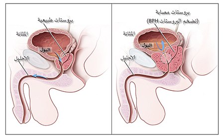 مخطط يوضح حجم البروستات الطبيعي (اليسار) وتضخم البروستات الحميد (اليمين).