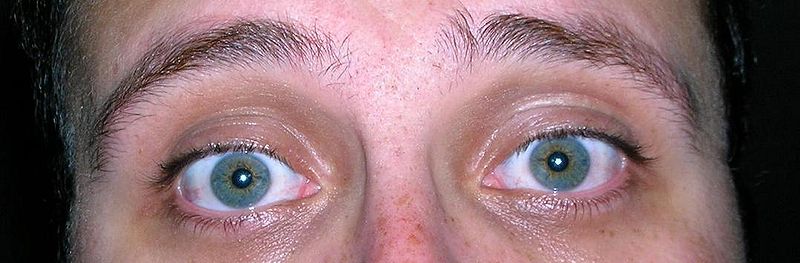 File:Blue-Green Eyes with Freckles.JPG