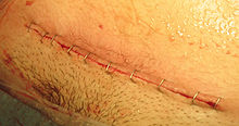 Closed incision for low transverse abdominal incision after stapling has been completed C-sec suture.jpg