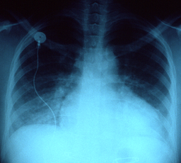 Congestive heart failure x-ray