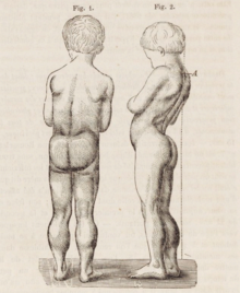 Drawing of seven-year-old boy with Duchenne muscular dystrophy. There is excessive development of the lower limbs (pseudohypertrophy), and thinness of the arms. In the figure on the right, lumbar hyperlordosis is visible. Drawing of boy with Duchenne muscular dystrophy.png