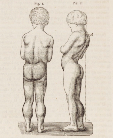 https://upload.wikimedia.org/wikipedia/commons/thumb/4/49/Drawing_of_boy_with_Duchenne_muscular_dystrophy.png/394px-Drawing_of_boy_with_Duchenne_muscular_dystrophy.png