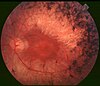 Очне дно хворого на пігментний ретиніт