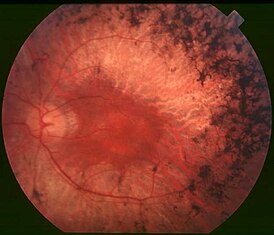 Глазное дно пациента с пигментным ретинитом в средней стадии (твёрдые спикулообразные пигментные отложения присутствуют в середине периферии вместе с атрофией сетчатки, вместе с тем макула сохранена,хотя и с периферийным кольцом депигментации.Сосуды сетчатки ослаблены.) Из обзора Кристиана Амеля, 2006.