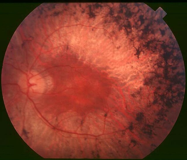 people with retinitis pigmentosa