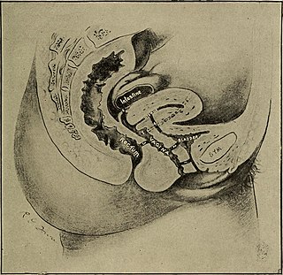 <span class="mw-page-title-main">Ureterovaginal fistula</span> Medical condition