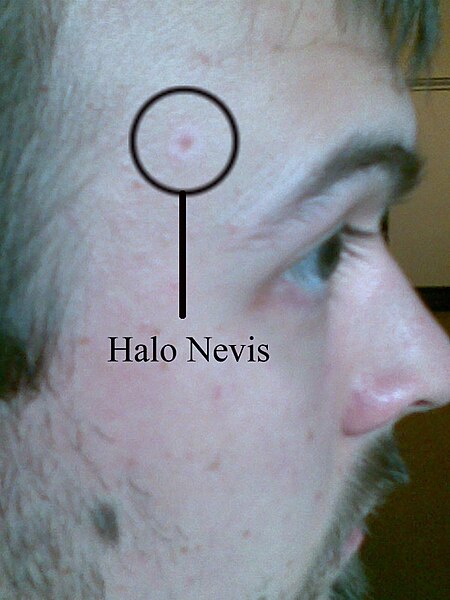 File:Halo Nevus text.jpg