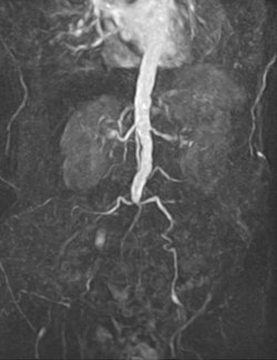 Leriche Syndrom 76w - MRA.jpg