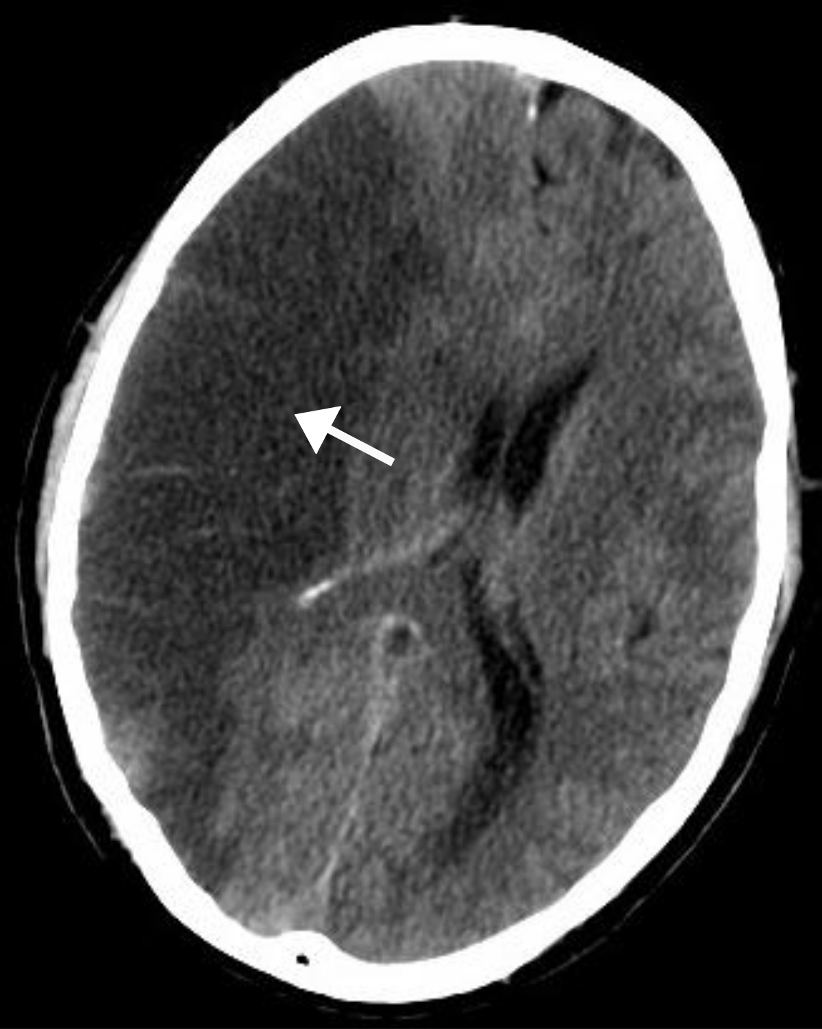 edem al genunchiului de la accident vascular cerebral)