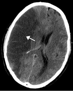 <span class="mw-page-title-main">Stroke</span> Death of a region of brain cells due to poor blood flow