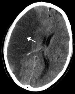 Cerebrovasculair Accident