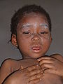 Παιδί αφρικανικής καταγωγής που έχει προσβληθεί από ιλαρά.