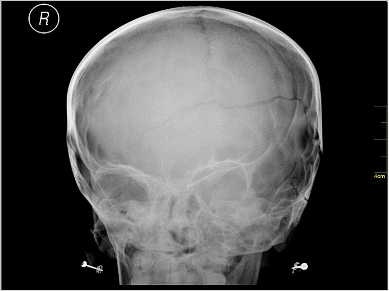 File:Medical X-Ray imaging GTN04 nevit.jpg