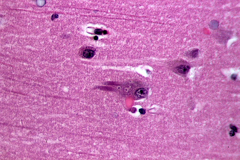 File:Neurofibrillary tangles in the Hippocampus of an old person with Alzheimer-related pathology, HE 5.JPG