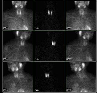 <span class="mw-page-title-main">Sestamibi parathyroid scan</span> Procedure in nuclear medicine