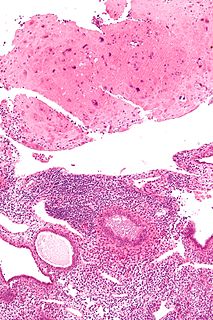 Placental site nodule Human disease