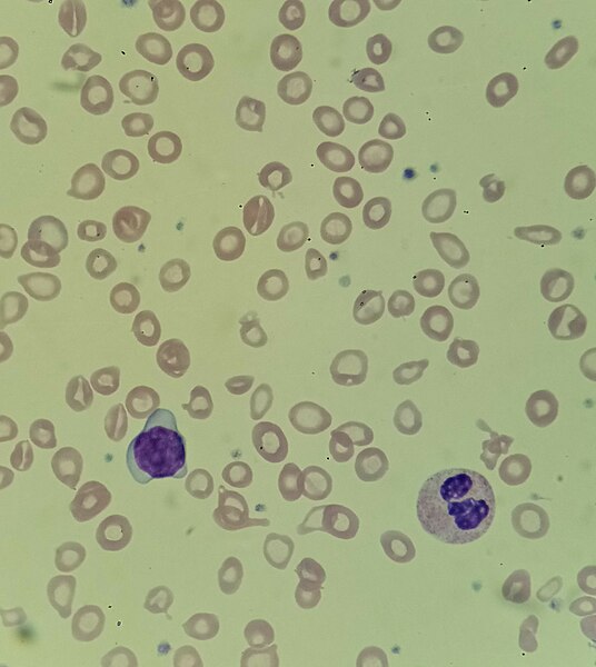File:Severe iron deficiency anemia.jpg