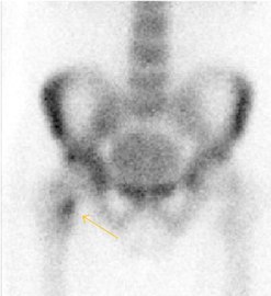 In this case, Tc 99 scintigraphy shows a band of uptake[1]