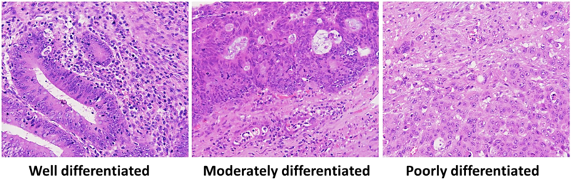File:Well-, moderately and poorly differentiated colorectal adenocarcinoma.png