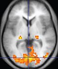 Thumbnail for Functional magnetic resonance imaging