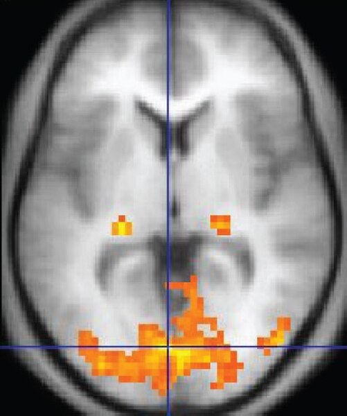 Functional magnetic resonance imaging is a neuroimaging technique to detect brain areas with increased neural activity (shown in orange).