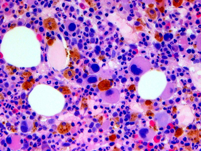 File:5q- syndrome Bone marrow.jpg