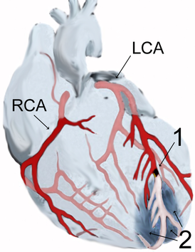 Диаграмма инфаркта миокарда (2) в области передней стенки (апикальный инфаркт) после закупорки ветви левой коронарной артерии