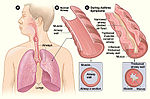 Um ataque de asma provoca o estreitamento das vias respiratórias e a produção de muco em excesso, o que torna a respiração difícil