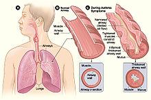 Figure showing the physiological changes in the respiratory tract during an asthma attack upon contact with a trigger Asthma attack-illustration NIH.jpg