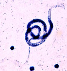 elephantiasis parazita)