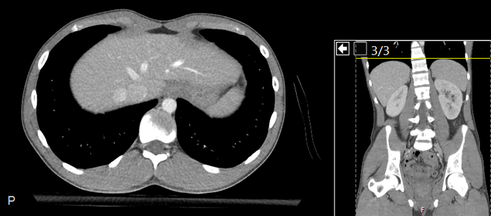 CT of a normal abdomen and pelvis, axial plane 33.png