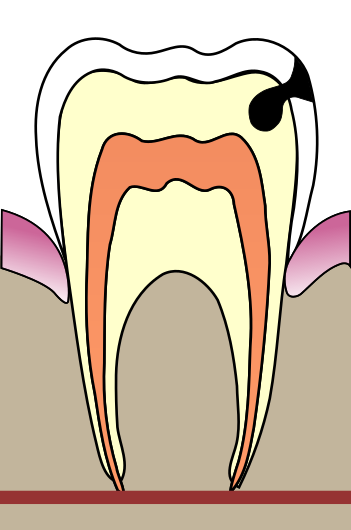 Cavities evolution 3.svg