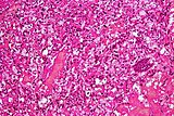 Cérébelleuse hemangioblastoma Intermed mag.jpg