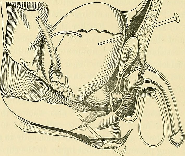 File:Clinical lectures on stricture of the urethra and other disorders of the urinary organs (1878) (14595034530).jpg