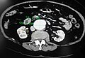 A transverse contrast enhanced CT scan demonstrating an abdominal aortic aneurysm of 4.8 by 3.8 cm