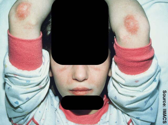 myositis skin rash