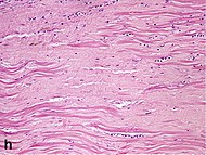 Histopathology of dense fibrous scar replacing myocyte loss in myocardial infarction.jpg