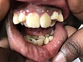 Hyperdontia - Genetically inherited development of overcomplete teeth. 2.jpg