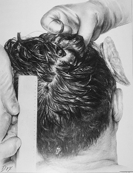 File:JFK posterior head wound.jpg - Wikimedia Commons