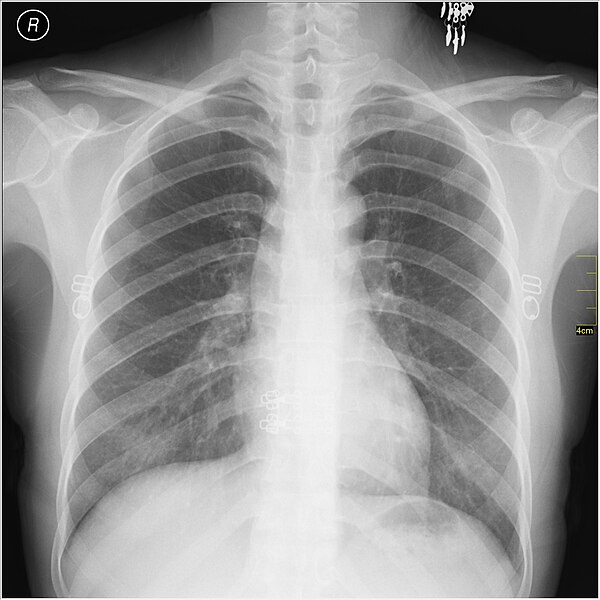 File:Medical X-Ray imaging PFM06 nevit.jpg