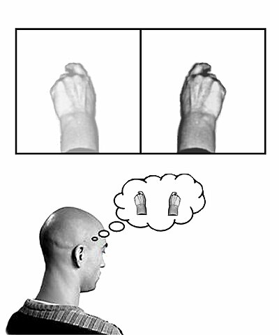 A diagrammatic explanation of the mirror box. The patient places the intact limb into one side of the box (in this case the right hand) and the amputated limb into the other side. Due to the mirror, the patient sees a reflection of the intact hand where the missing limb would be (indicated in lower contrast). The patient thus receives artificial visual feedback that the "resurrected" limb is now moving when they move the good hand.